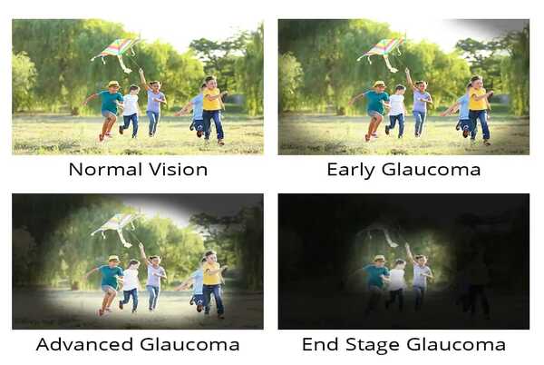 BEST EYE HOSPITAL IN KANPUR ADARSH EYE HOSPITAL WWW.ADARSHEYEHOSPITAL.COM BEST EYE SURGEON